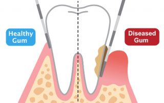 Periodontal Pockets