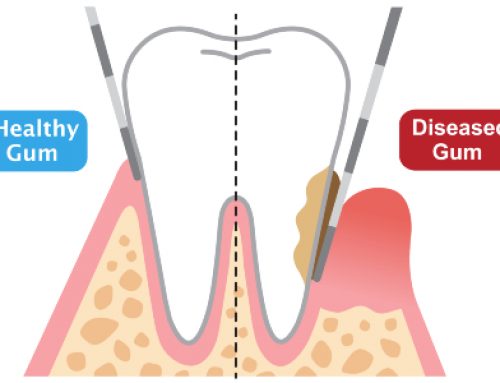 Periodontal Pockets