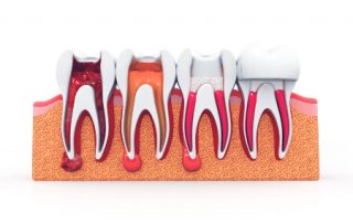 Stages of Root Canal Treatment