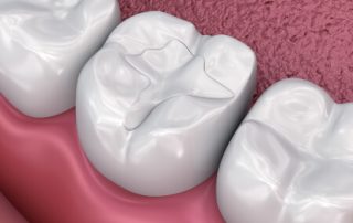 Tooth-Colored Fillings