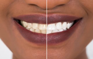 Before and After Teeth Whitening