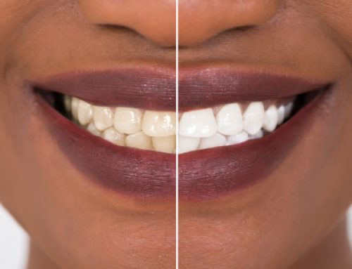 Thinking About Teeth Whitening?
