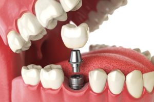 Dental Implant Illustration