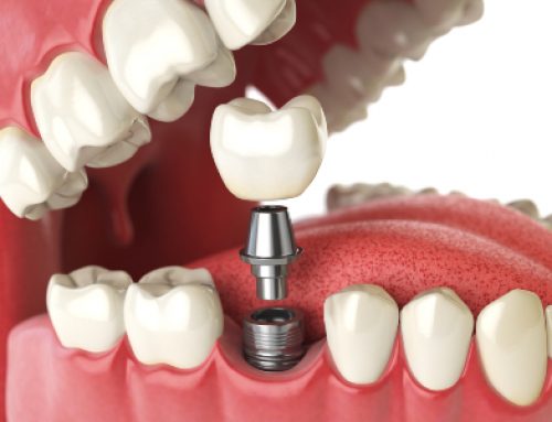 Ready For Dental Implants?