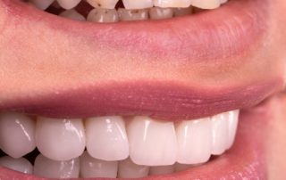 Smile Restoration