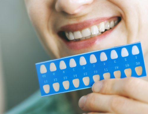 What Is Internal Whitening?